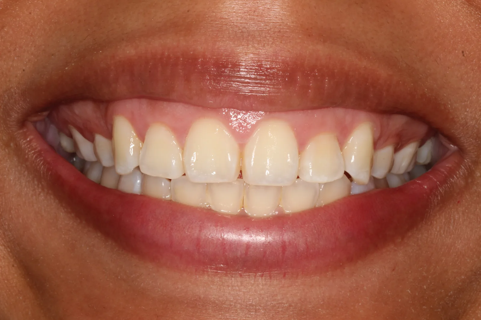 Antes de la gingivectomía en Panamá