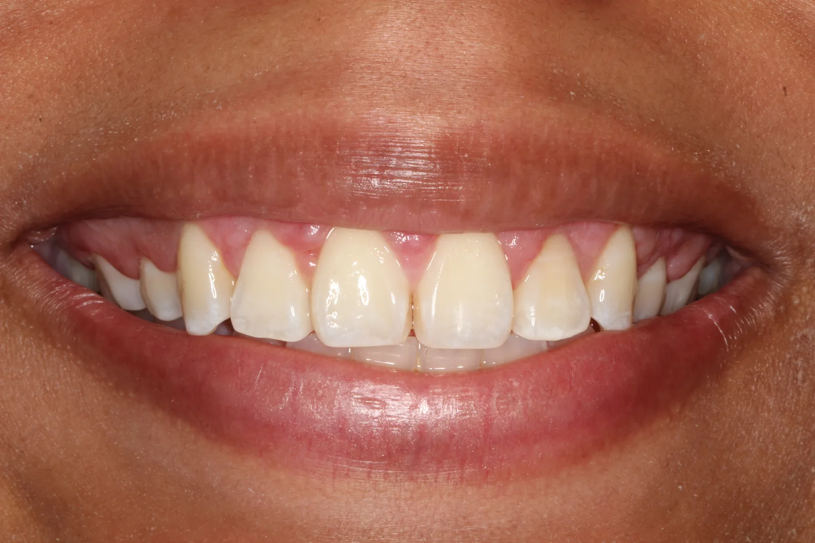 Después de la gingivectomía en Panamá
