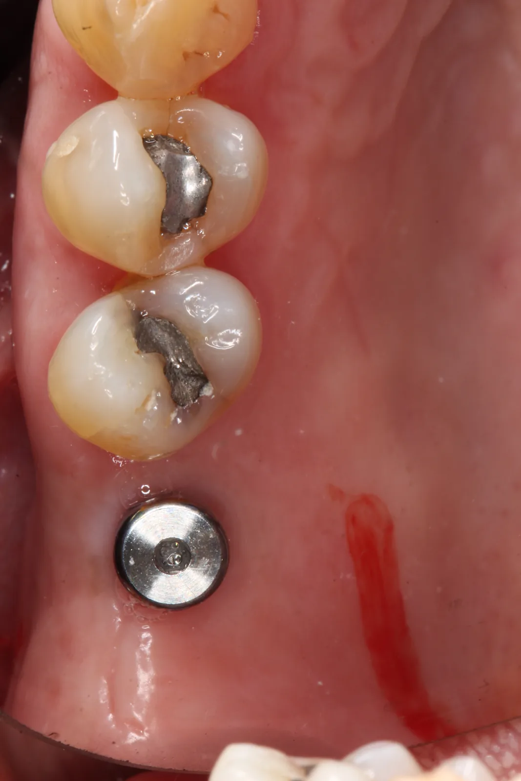 Antes del implante dental en Panamá