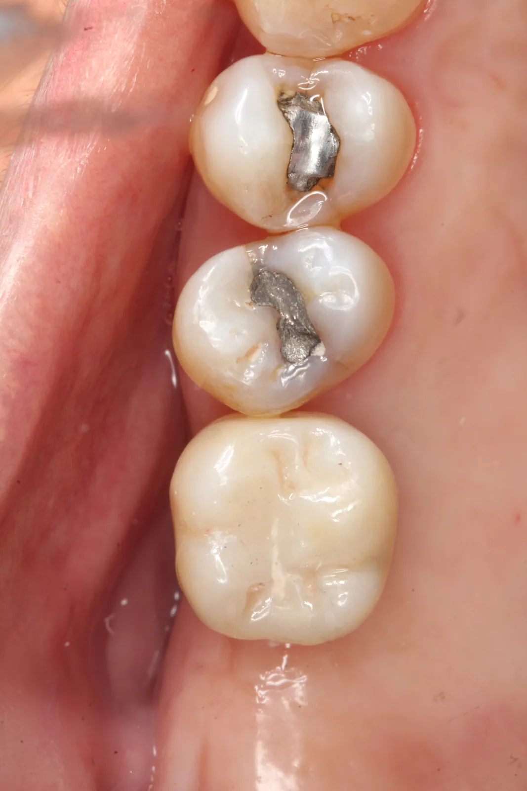 Después del implante dental en Panamá