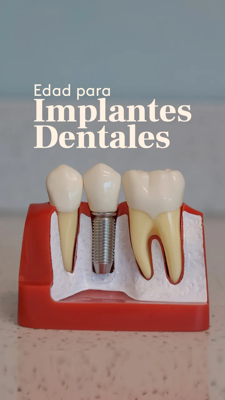 Edad para implantes dentales